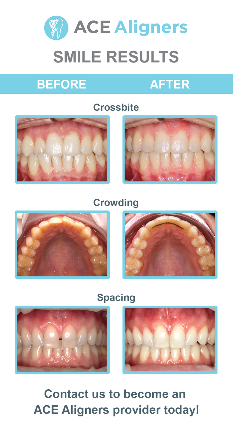 ACE Aligner: Custom Orthodontic Clear Aligners